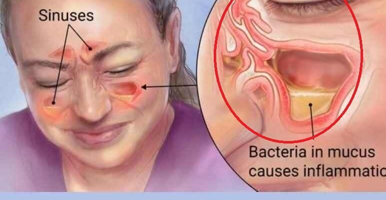 Ceaiul care te scapă de streptococul în gât, gripă și infecțiile sinusurilor – Remediu natural cu oregano