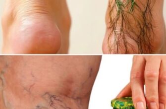 Acest remediu pentru varice folosind rozmarin este incredibil! Am încercat lunea trecută și am văzut rezultatele rapid. E atât de ușor de făcut acasă cu niște ingrediente simple. Sora mea a fost uimită! E sănătos și natural...