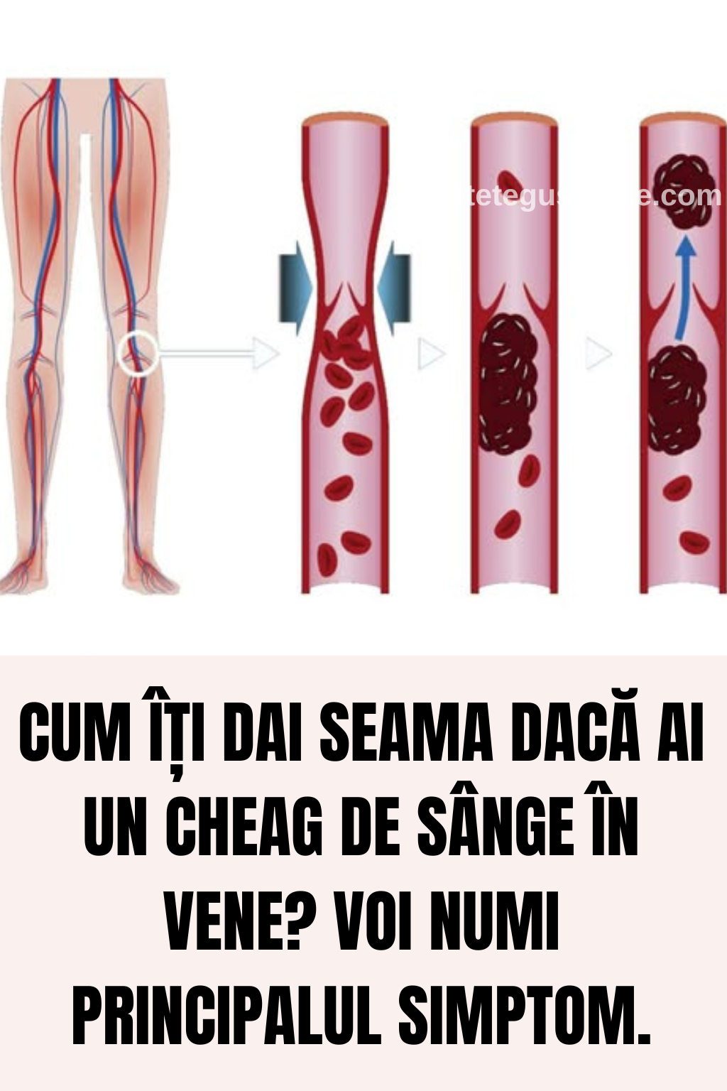 Cum îți dai seama dacă ai un cheag de sânge în vene? Voi numi principalul simptom.