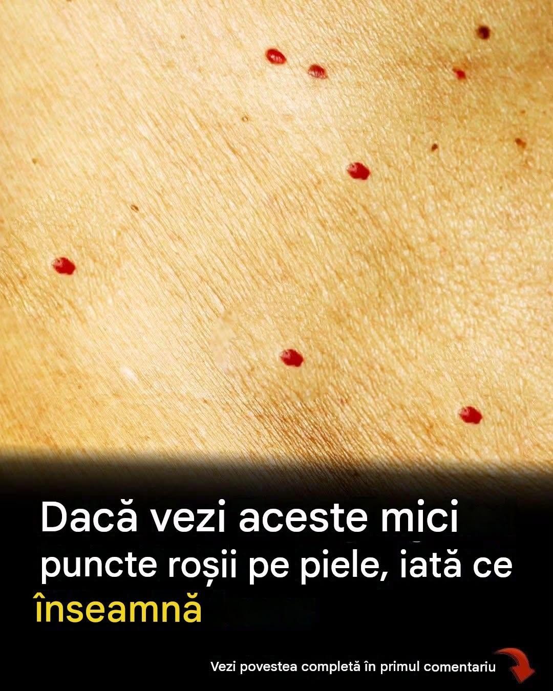 Puncte roșii pe piele: cauze și ce ar putea însemna